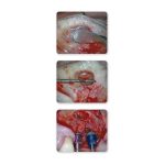 Sinus Lift Instrument Set — Helmut Zepf